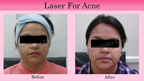 Acne Scar Treatment in Chandigarh