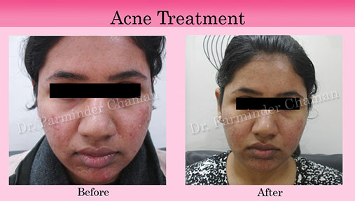 Scar Removal Treatment