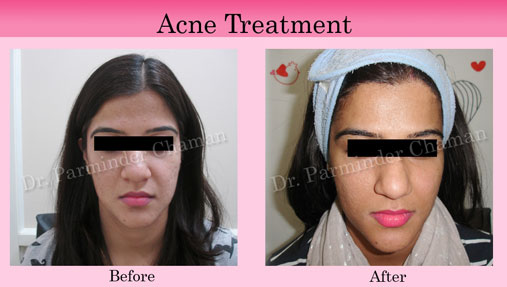 Skin Doctor for Acne