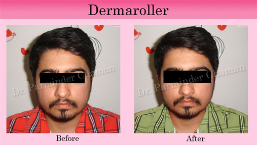 Best Cosmetic and Laser Treatment in Chandigarh