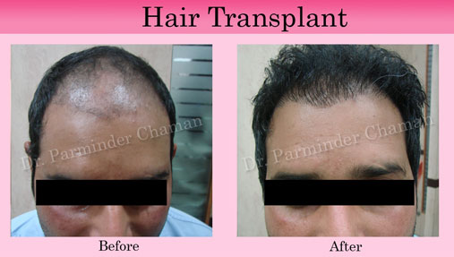 Hair Treatment in Punjab