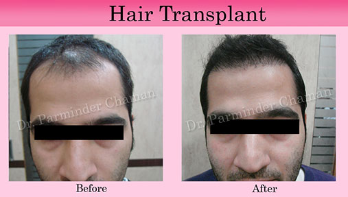 Hair Fall Treatment in Chandigarh