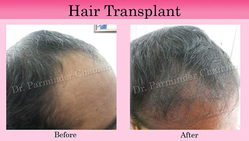 Dermatologist for Hair Treatment