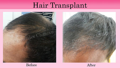 Hair Fall Control with PRP Treatment