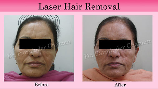 Laser Hair Removal in Mohali