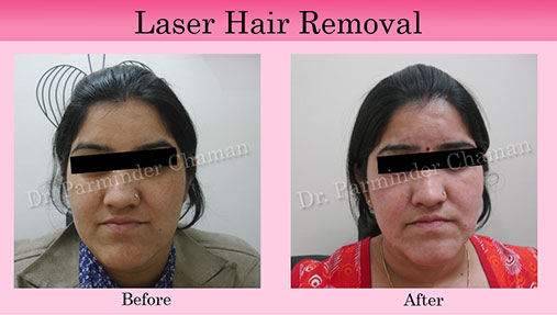 Clinic for Hair Removal in Chandigarh