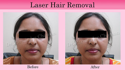 Chandigarh Laser Hair Removal