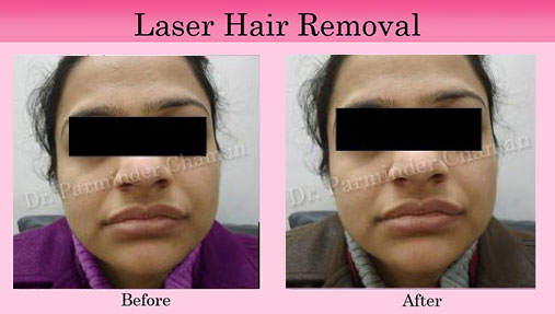 Punjab Laser Hair Removal
