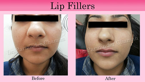 Lip Fillers Clinic in Chandigarh