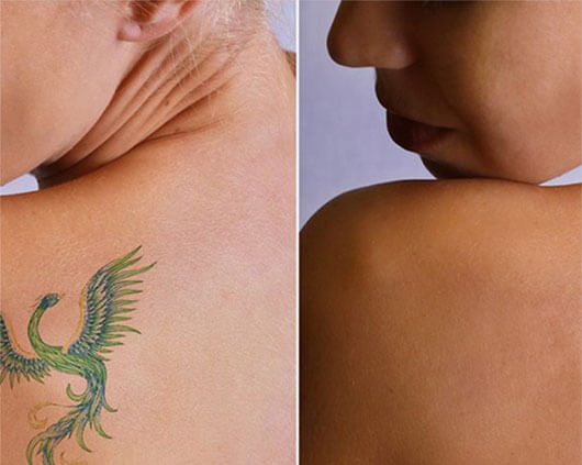 Tattoo Removal in Chandigarh | Permanent Tattoo Removal Clinic