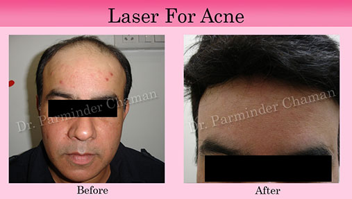 Acne Treatment Chandigarh
