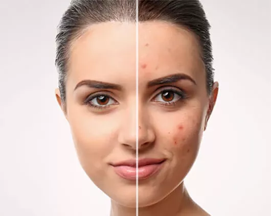 Acne Treatment in Chandigarh