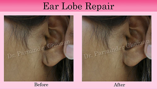 Stitchless Ear Lobe Repair Chandigarh