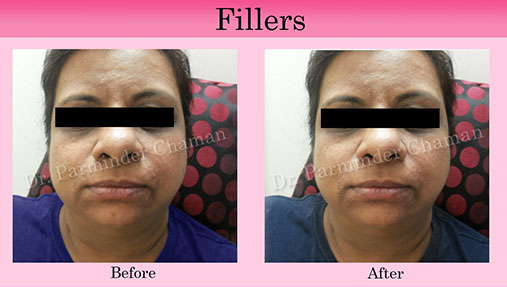 Botox Fillers in Chandigarh