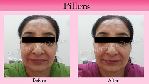 Botox Fillers Injection Results