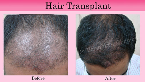 Hair Loss Treatment in Chandigarh