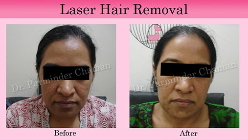 Mohali Laser Hair Removal