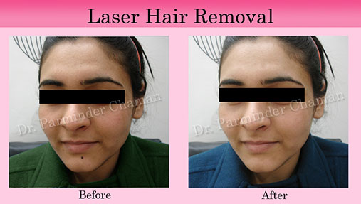 Clinic for Laser Hair Removal