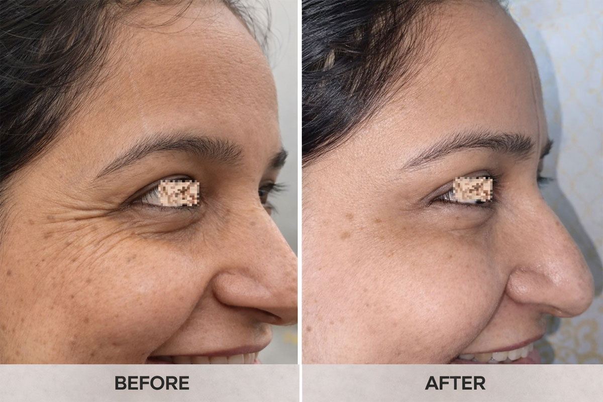 Botox results before after