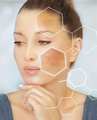 Hyperpigmentation and Dark Spots Treatment in Chandigarh