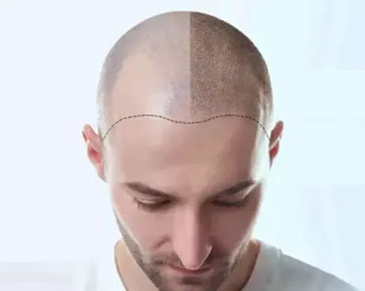 Hair Transplant in Chandigarh