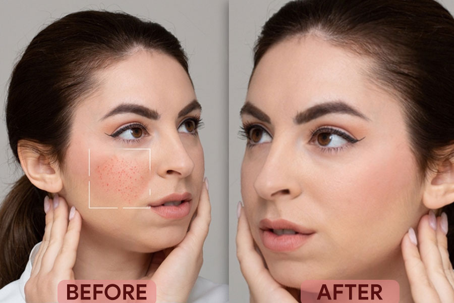 Pimple Treatment at Panache Skin Clinic - Chandigarh