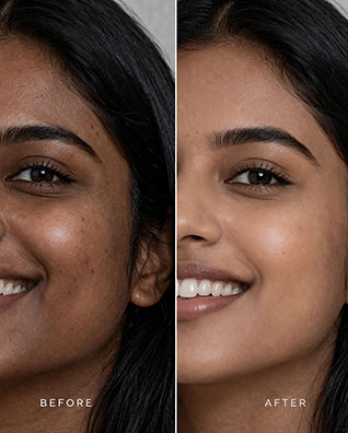 Skin Brightening Laser Treatment