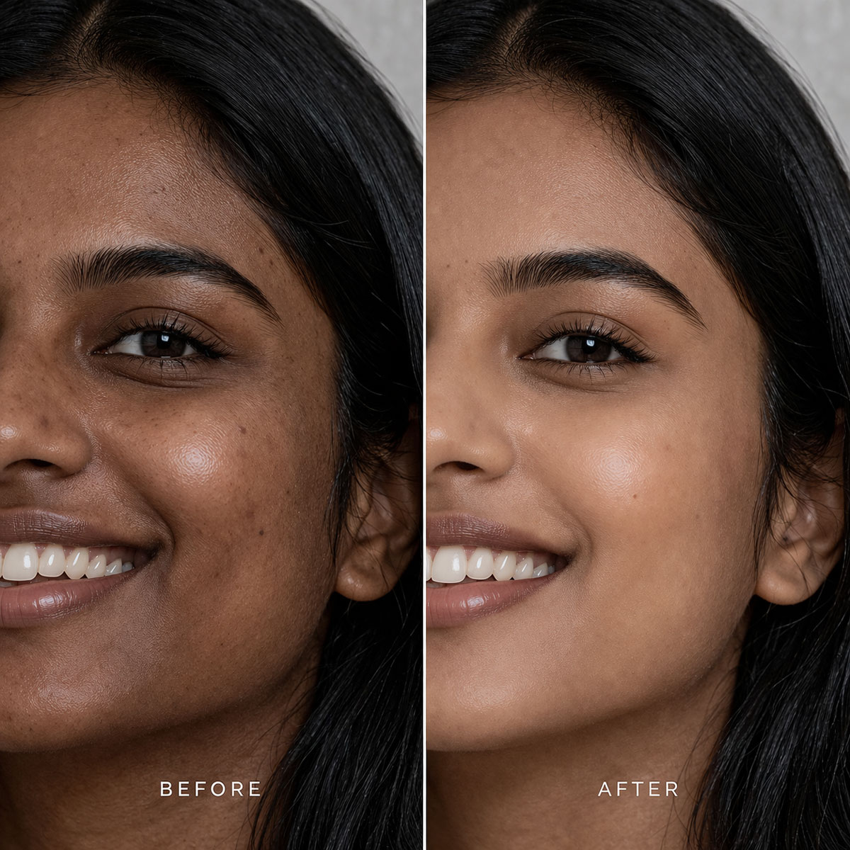 Laser skin brightening treatment