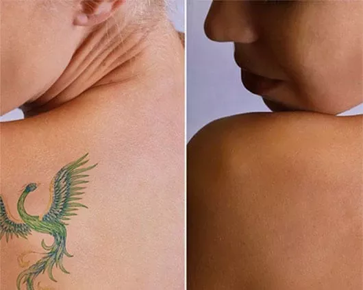 Laser Tattoo Removal in Chandigarh